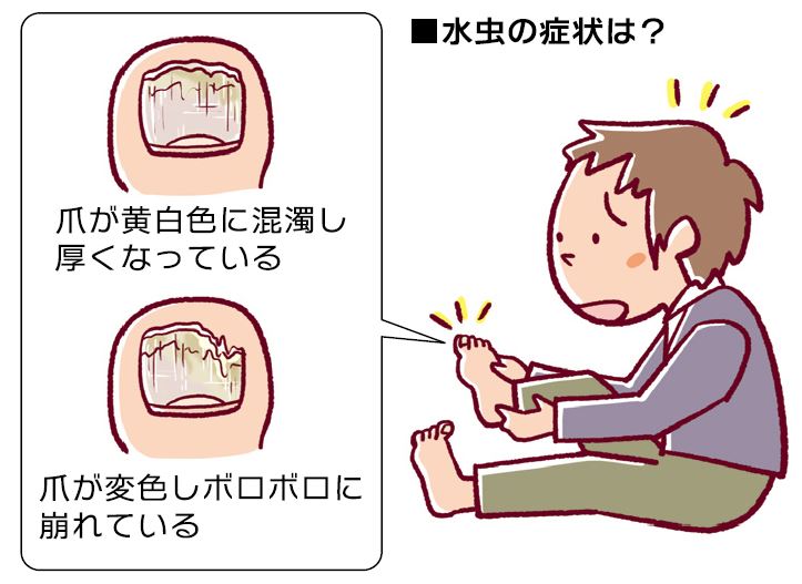 症状が出やすい夏こそ放置は禁物 爪水虫